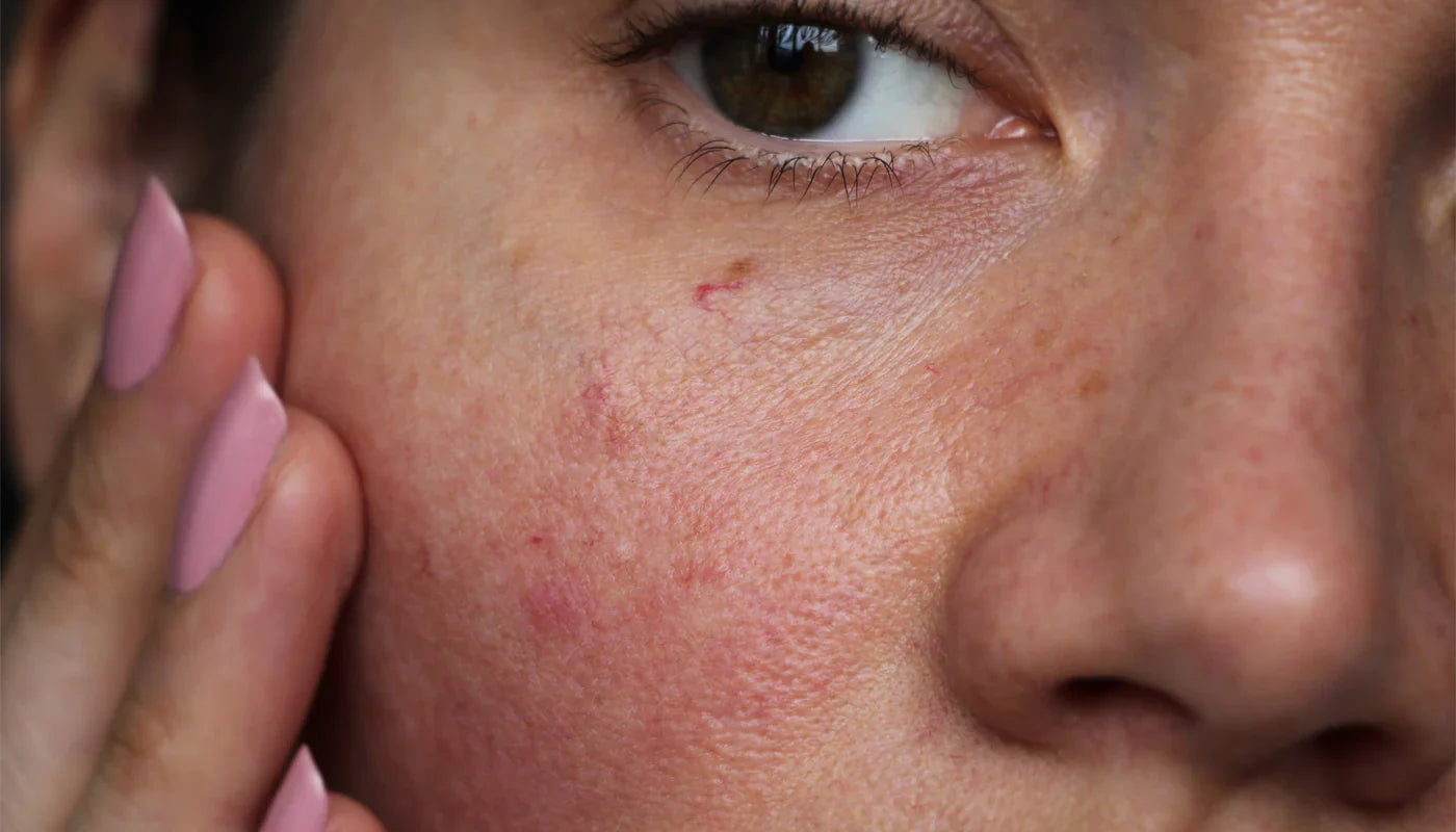 How to Manage Dryness and Flaking in Sensitive Skin